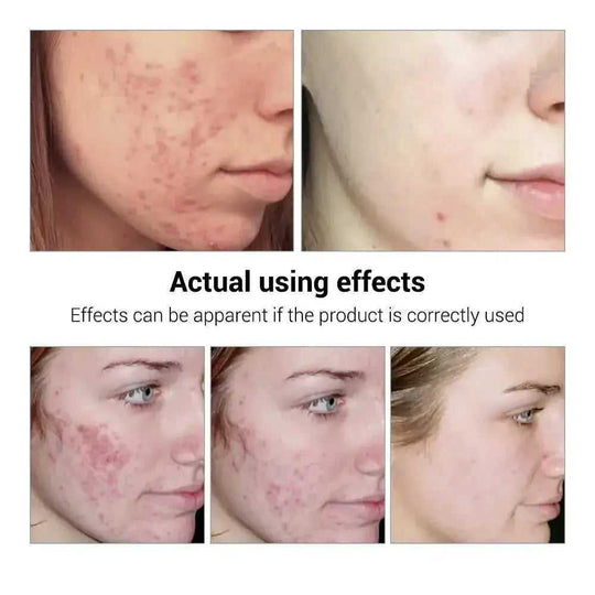 BREYLEE Acne Treatment Serum Face Facial Anti Acne Scar Removal Cream Skin Care Whitening Repair Pimple Remover For Acne - Meifu Market