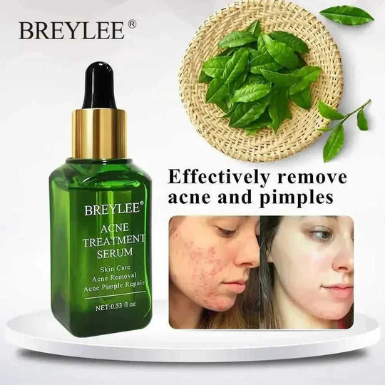 BREYLEE Acne Treatment Serum Face Facial Anti Acne Scar Removal Cream Skin Care Whitening Repair Pimple Remover For Acne - Meifu Market
