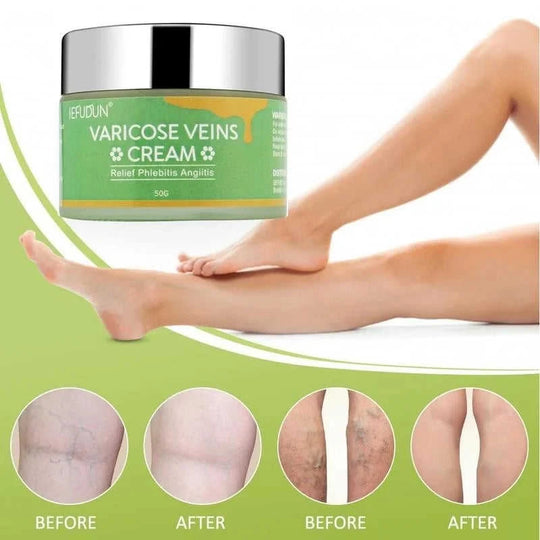 varicose veins cream for legs | spider veins treatment cream | leg pain relief cream | energy saving