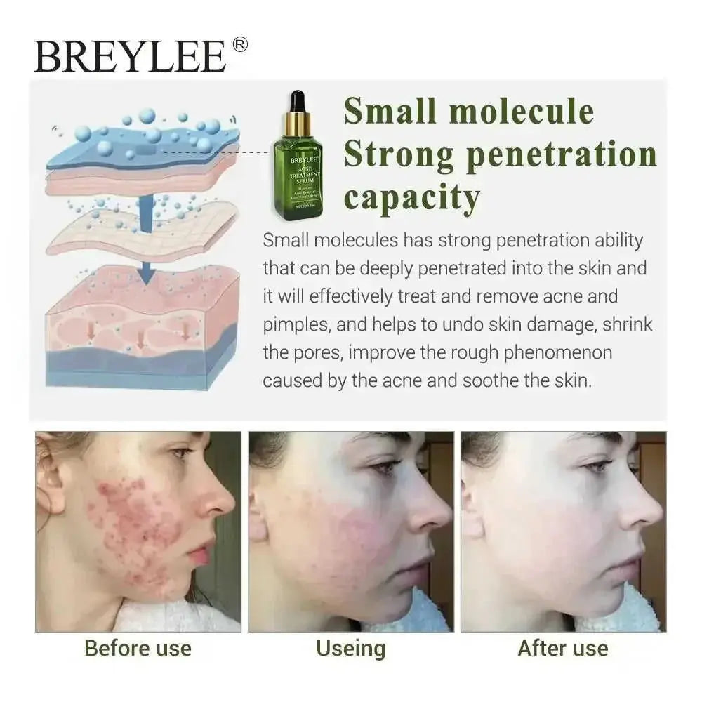 BREYLEE Acne Treatment Serum Face Facial Anti Acne Scar Removal Cream Skin Care Whitening Repair Pimple Remover For Acne - Meifu Market