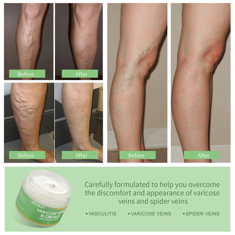 varicose veins cream for legs | spider veins treatment cream | leg pain relief cream | ultrasonic cleaning