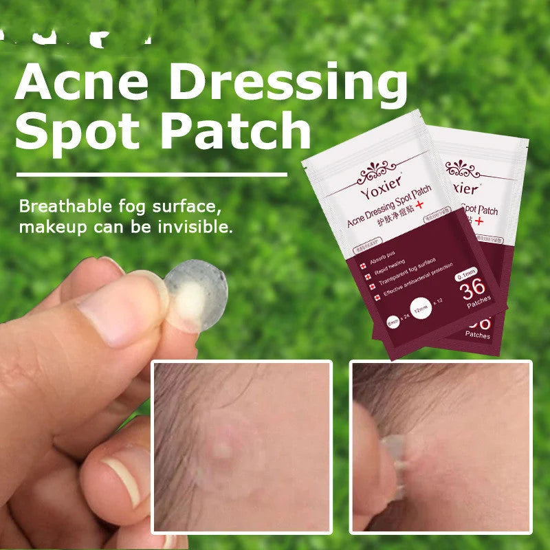 invisible acne patches | hydrocolloid pimple patches | acne spot treatment stickers | ultrasonic cleaning