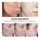 BREYLEE Acne Treatment Serum Face Facial Anti Acne Scar Removal Cream Skin Care Whitening Repair Pimple Remover For Acne - Meifu Market