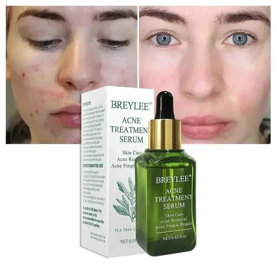 BREYLEE Acne Treatment Serum Face Facial Anti Acne Scar Removal Cream Skin Care Whitening Repair Pimple Remover For Acne - Meifu Market