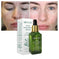 BREYLEE Acne Treatment Serum Face Facial Anti Acne Scar Removal Cream Skin Care Whitening Repair Pimple Remover For Acne - Meifu Market