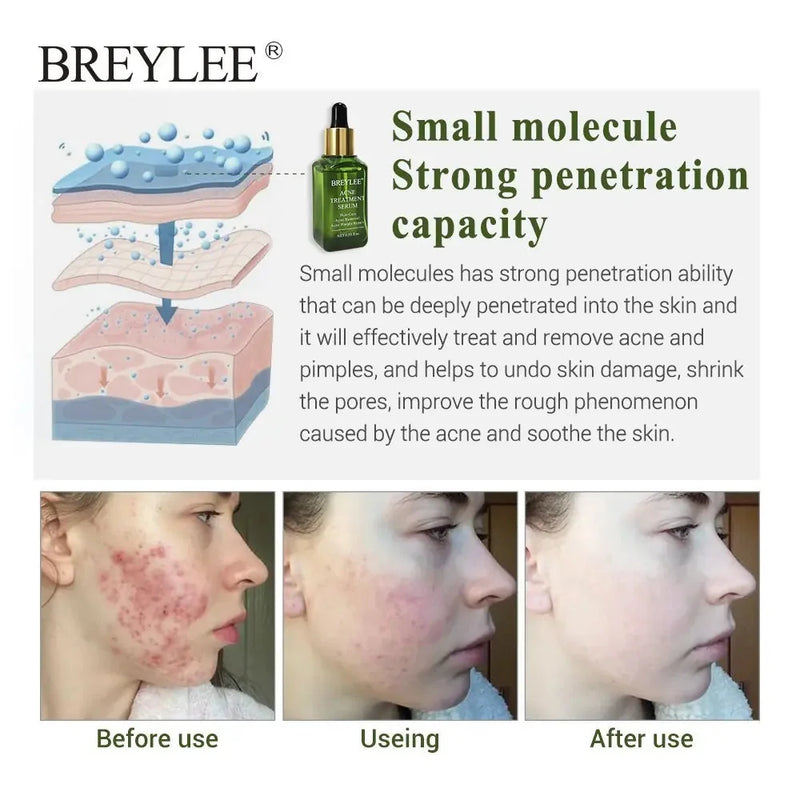 acne scar removal serum | salicylic acid acne treatment | niacinamide brightening cream | ultrasonic cleaning